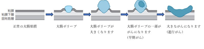 大腸がんは多いですか？大腸ポリープと関係ありますか