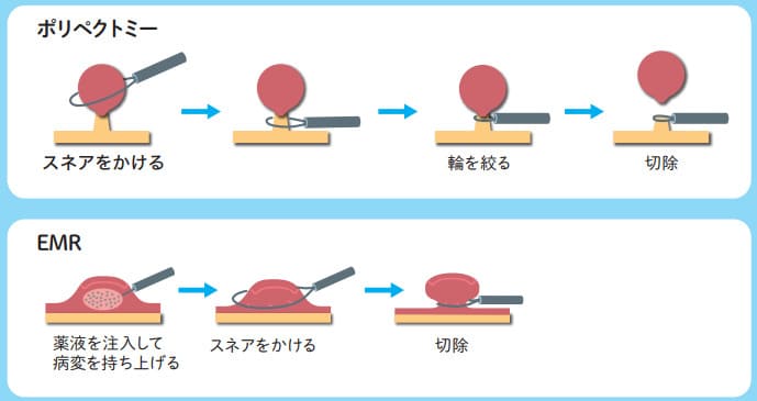 大腸ポリープが見つかったら治療もしてもらえますか?