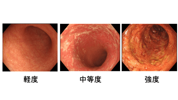 大腸の粘膜の炎症画像です。左から軽度、中等度、強度の炎症です。