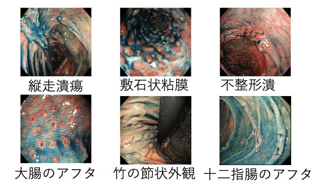 クローン病の炎症の様子です。縦走潰瘍、軟石状粘膜、不整形潰、大腸のアフタ、竹の節状外観、十二指腸のアフタ。